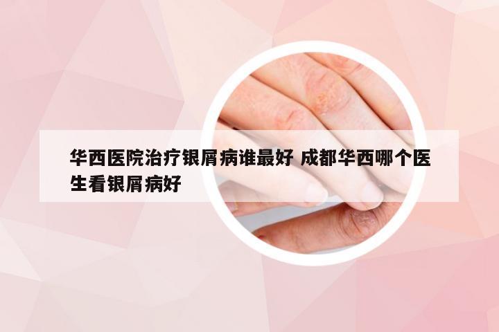 华西医院治疗银屑病谁最好 成都华西哪个医生看银屑病好