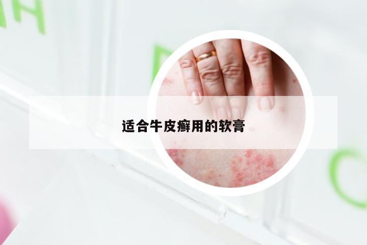 适合牛皮癣用的软膏