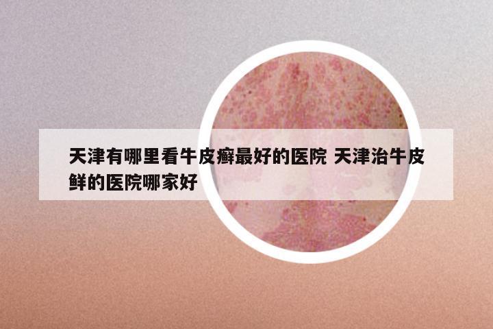 天津有哪里看牛皮癣最好的医院 天津治牛皮鲜的医院哪家好