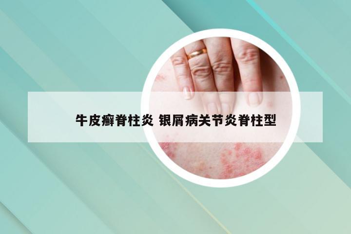 牛皮癣脊柱炎 银屑病关节炎脊柱型