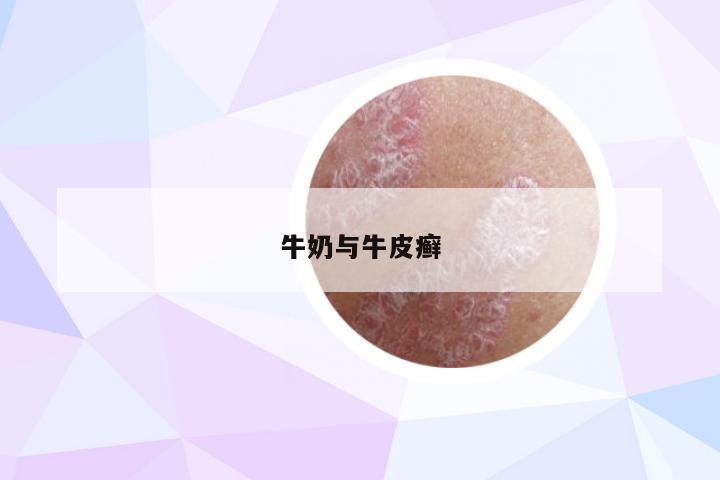 牛奶与牛皮癣