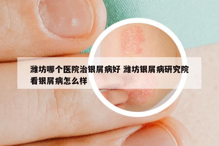 潍坊哪个医院治银屑病好 潍坊银屑病研究院看银屑病怎么样