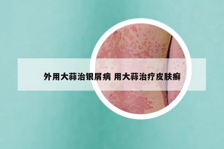 外用大蒜治银屑病 用大蒜治疗皮肤癣