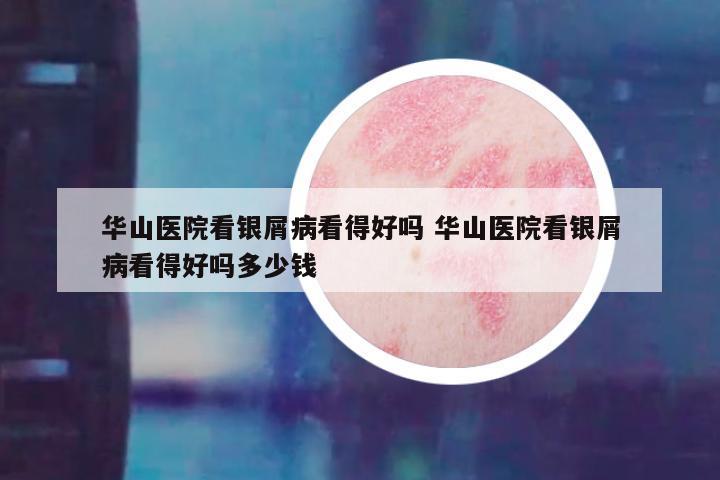 华山医院看银屑病看得好吗 华山医院看银屑病看得好吗多少钱