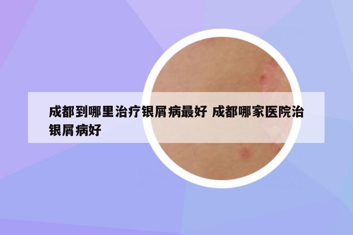 成都到哪里治疗银屑病最好 成都哪家医院治银屑病好