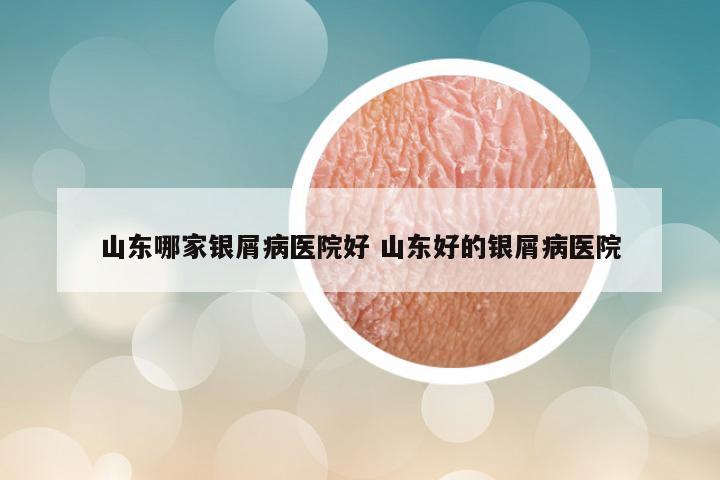 山东哪家银屑病医院好 山东好的银屑病医院