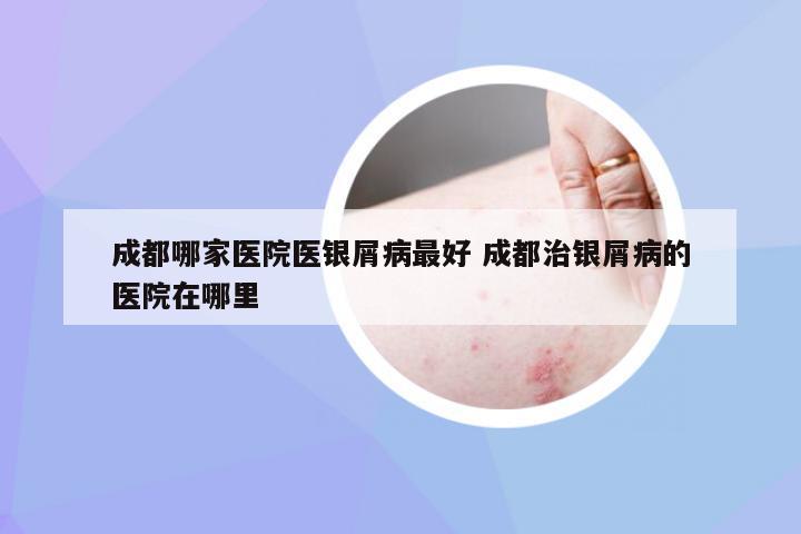 成都哪家医院医银屑病最好 成都治银屑病的医院在哪里