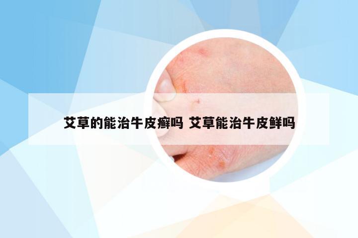 艾草的能治牛皮癣吗 艾草能治牛皮鲜吗