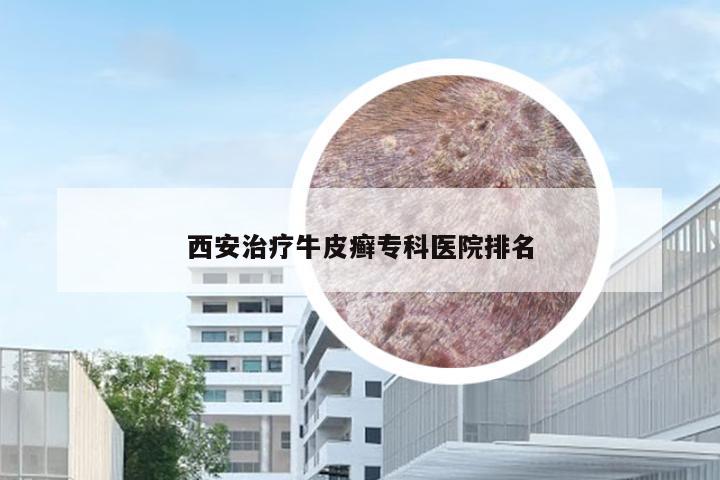 西安治疗牛皮癣专科医院排名