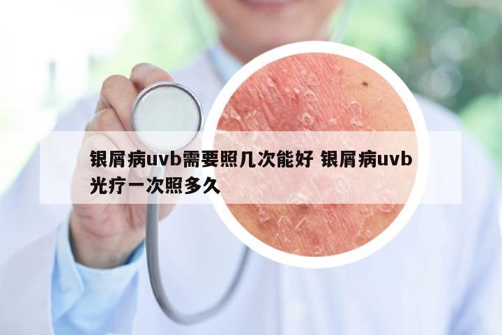 银屑病uvb需要照几次能好 银屑病uvb光疗一次照多久