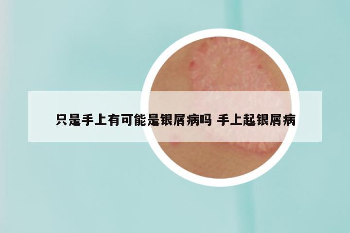 只是手上有可能是银屑病吗 手上起银屑病