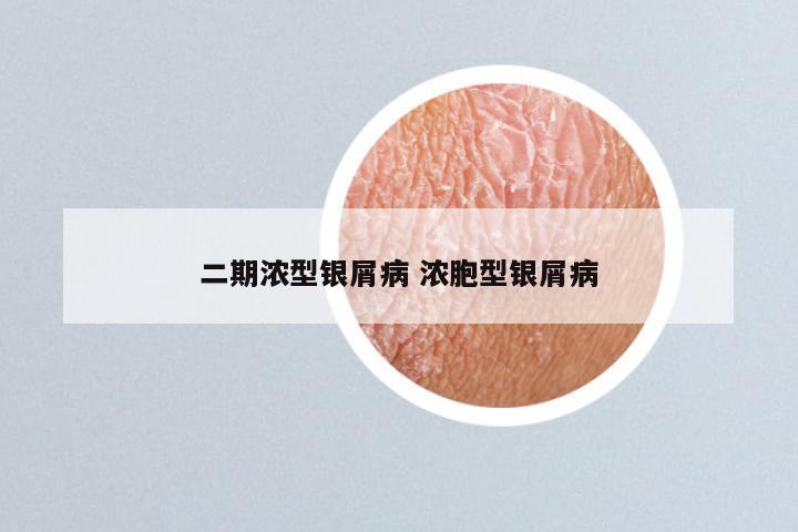 二期浓型银屑病 浓胞型银屑病