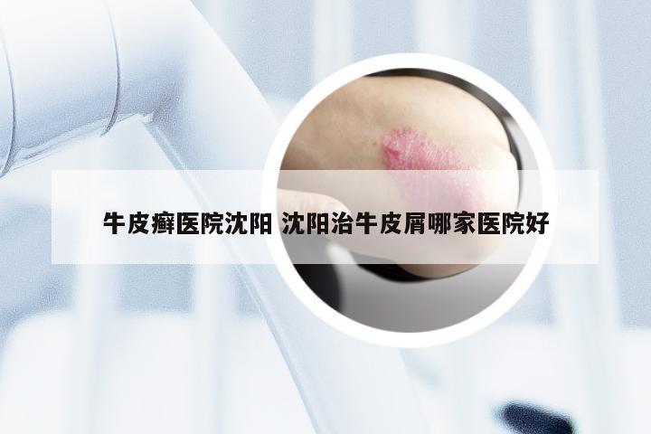 牛皮癣医院沈阳 沈阳治牛皮屑哪家医院好