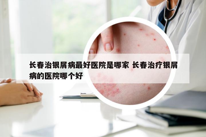 长春治银屑病最好医院是哪家 长春治疗银屑病的医院哪个好