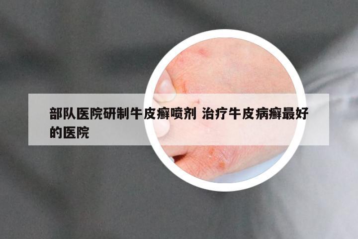 部队医院研制牛皮癣喷剂 治疗牛皮病癣最好的医院