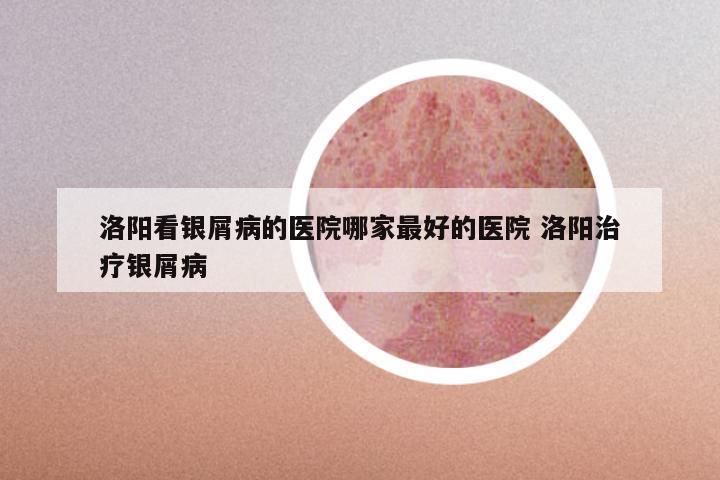 洛阳看银屑病的医院哪家最好的医院 洛阳治疗银屑病