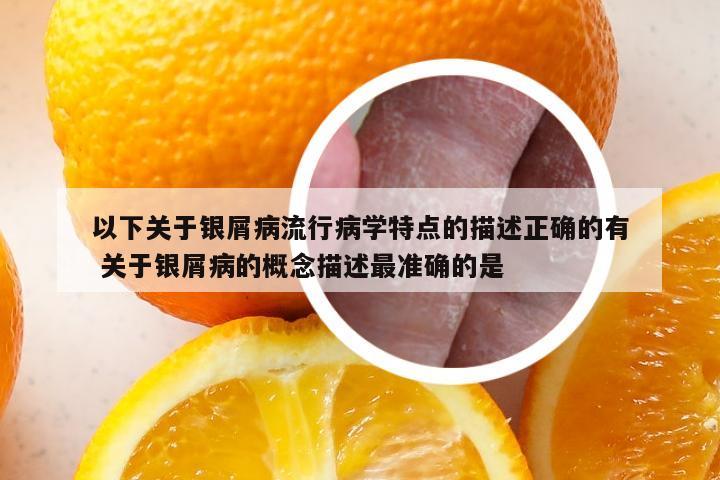 以下关于银屑病流行病学特点的描述正确的有 关于银屑病的概念描述最准确的是