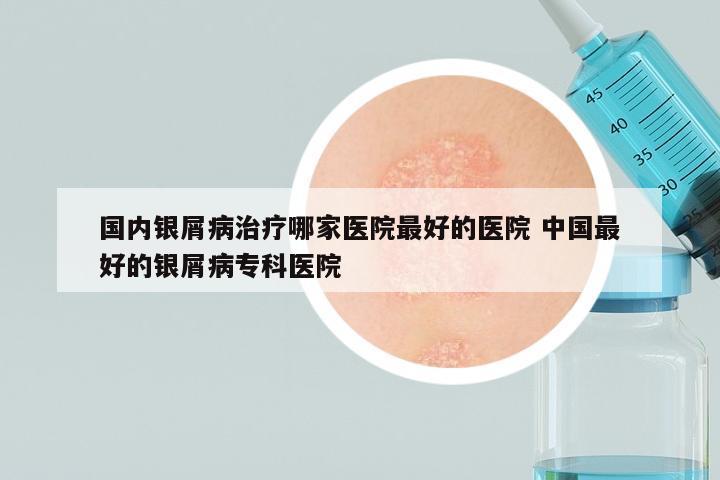 国内银屑病治疗哪家医院最好的医院 中国最好的银屑病专科医院