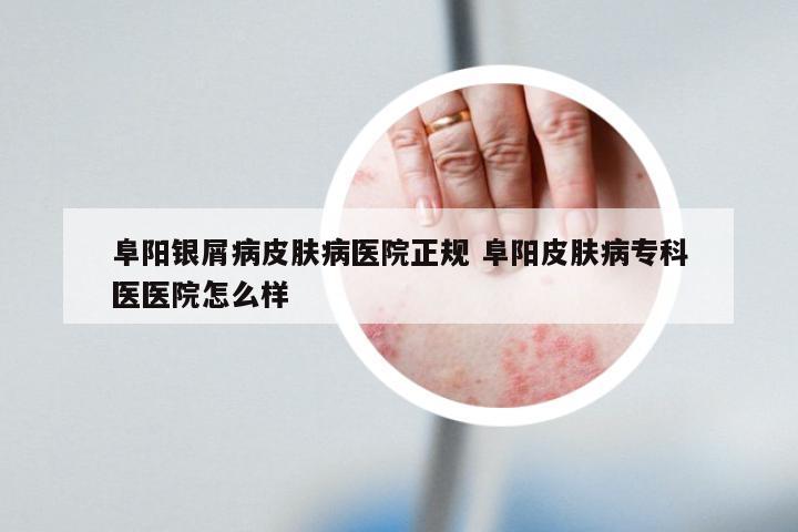 阜阳银屑病皮肤病医院正规 阜阳皮肤病专科医医院怎么样