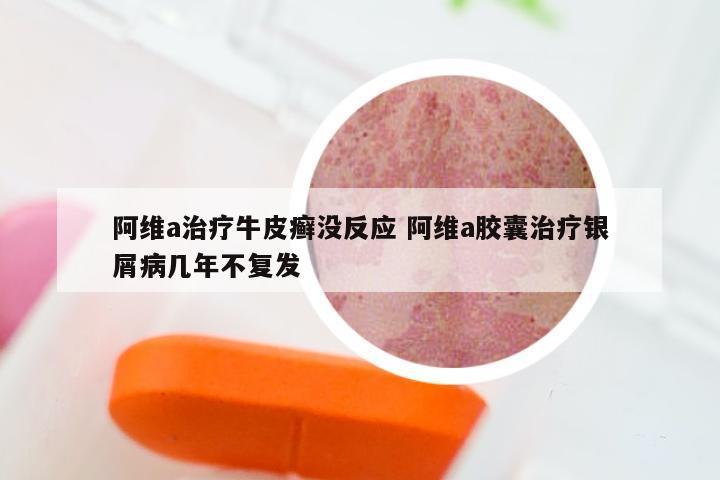 阿维a治疗牛皮癣没反应 阿维a胶囊治疗银屑病几年不复发