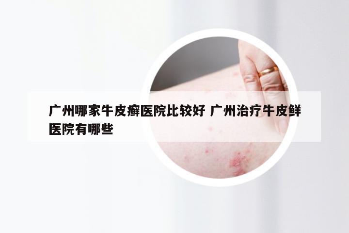 广州哪家牛皮癣医院比较好 广州治疗牛皮鲜医院有哪些