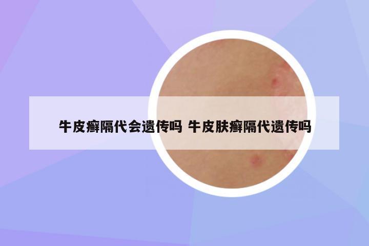 牛皮癣隔代会遗传吗 牛皮肤癣隔代遗传吗