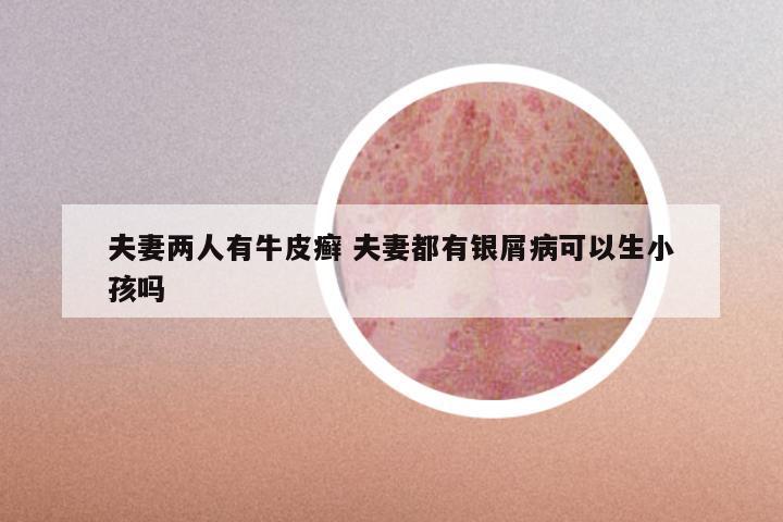 夫妻两人有牛皮癣 夫妻都有银屑病可以生小孩吗