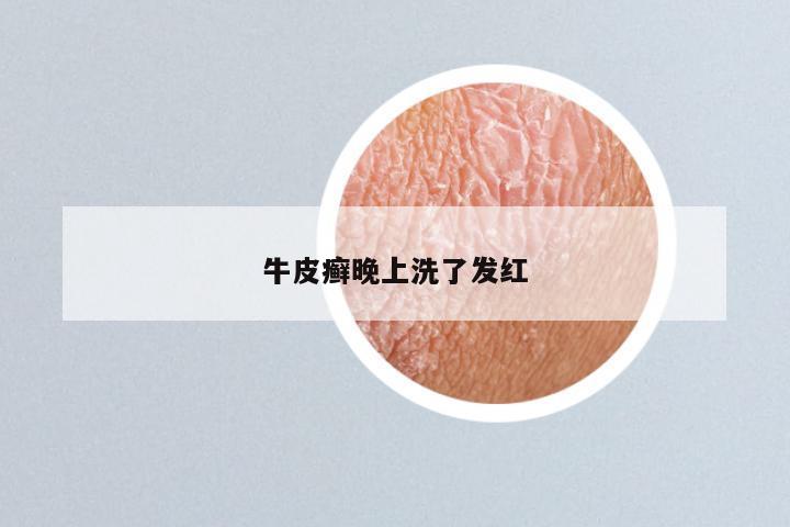 牛皮癣晚上洗了发红