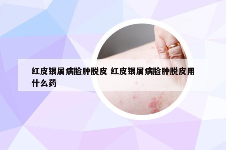 红皮银屑病脸肿脱皮 红皮银屑病脸肿脱皮用什么药