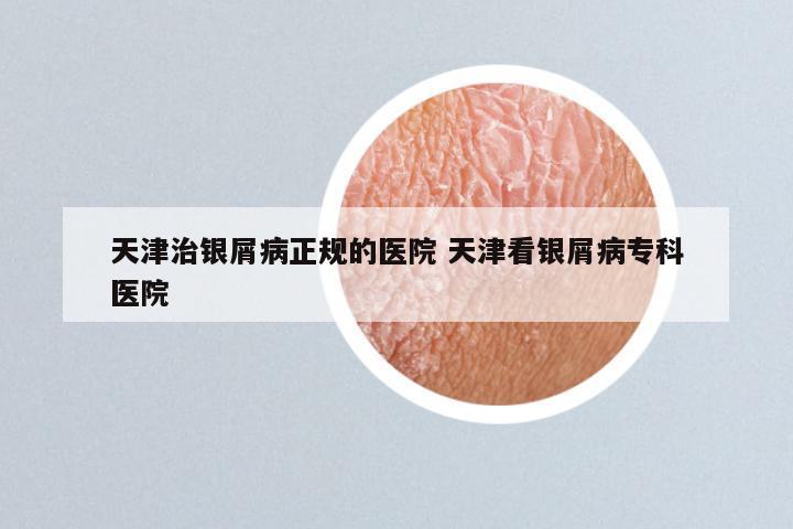 天津治银屑病正规的医院 天津看银屑病专科医院