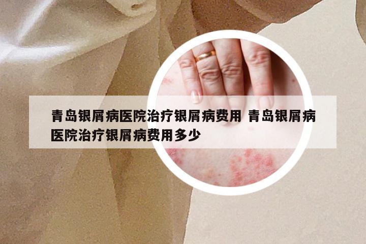 青岛银屑病医院治疗银屑病费用 青岛银屑病医院治疗银屑病费用多少