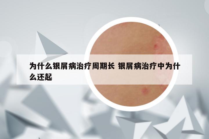 为什么银屑病治疗周期长 银屑病治疗中为什么还起