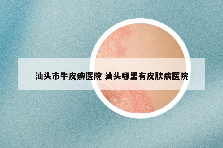 汕头市牛皮癣医院 汕头哪里有皮肤病医院