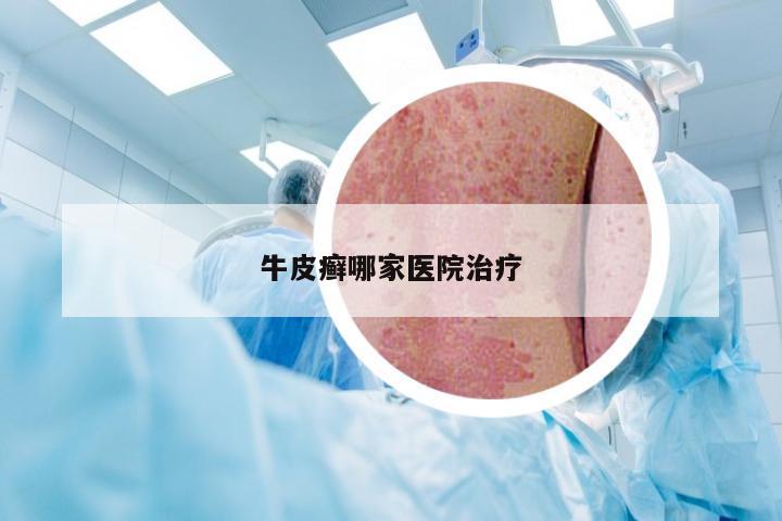 牛皮癣哪家医院治疗
