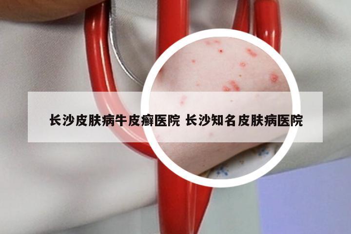 长沙皮肤病牛皮癣医院 长沙知名皮肤病医院