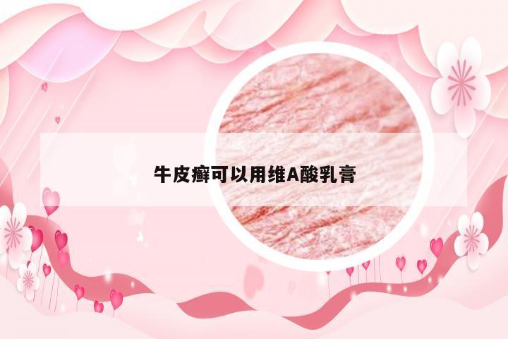 牛皮癣可以用维A酸乳膏