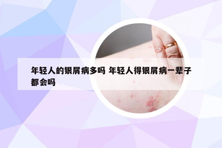 年轻人的银屑病多吗 年轻人得银屑病一辈子都会吗