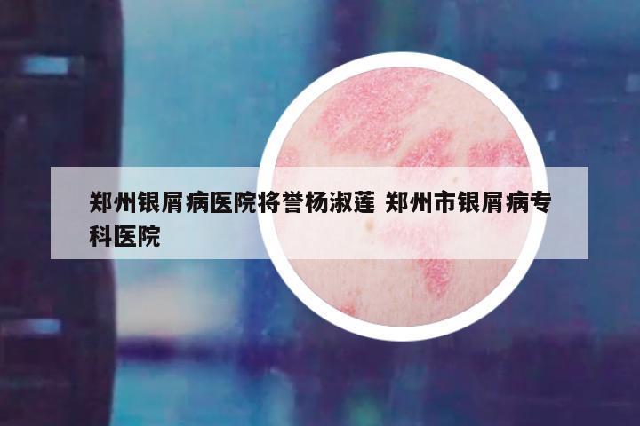 郑州银屑病医院将誉杨淑莲 郑州市银屑病专科医院