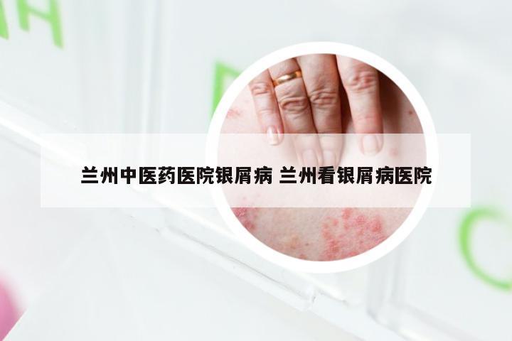 兰州中医药医院银屑病 兰州看银屑病医院