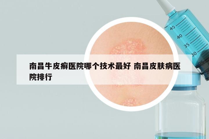 南昌牛皮癣医院哪个技术最好 南昌皮肤病医院排行