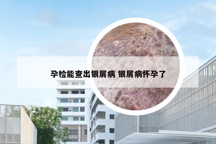 孕检能查出银屑病 银屑病怀孕了