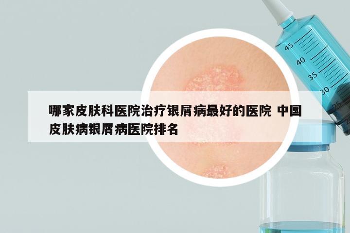 哪家皮肤科医院治疗银屑病最好的医院 中国皮肤病银屑病医院排名
