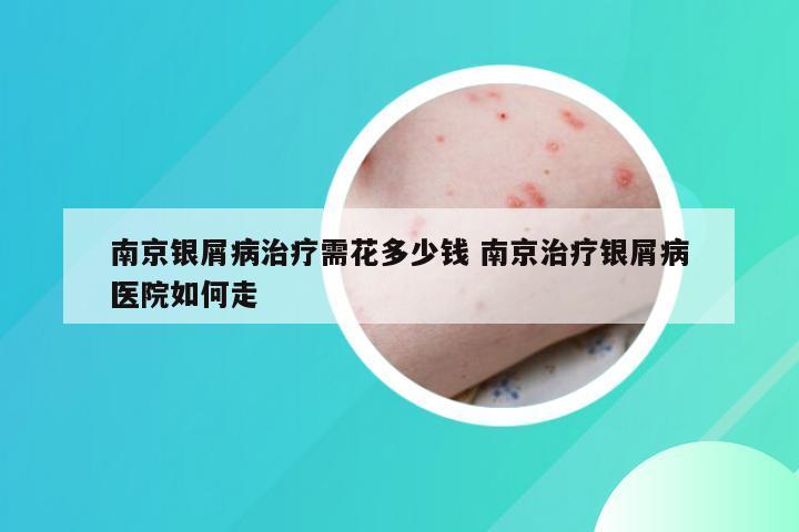 南京银屑病治疗需花多少钱 南京治疗银屑病医院如何走