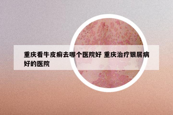 重庆看牛皮癣去哪个医院好 重庆治疗银屑病好的医院