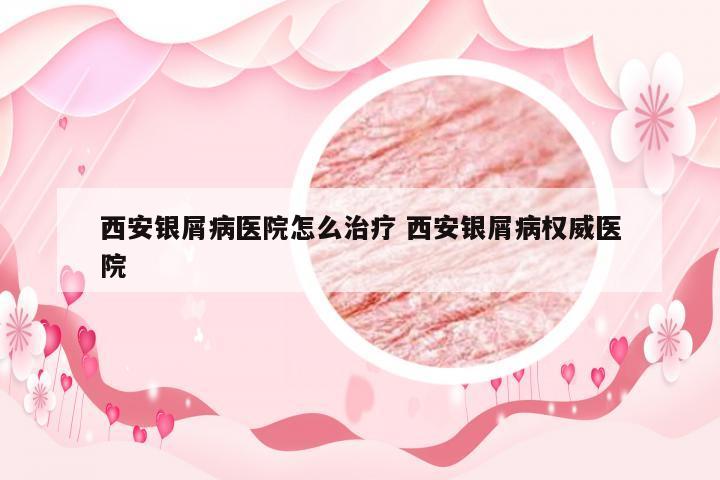 西安银屑病医院怎么治疗 西安银屑病权威医院