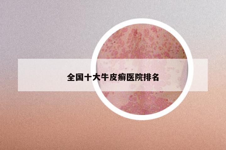 全国十大牛皮癣医院排名