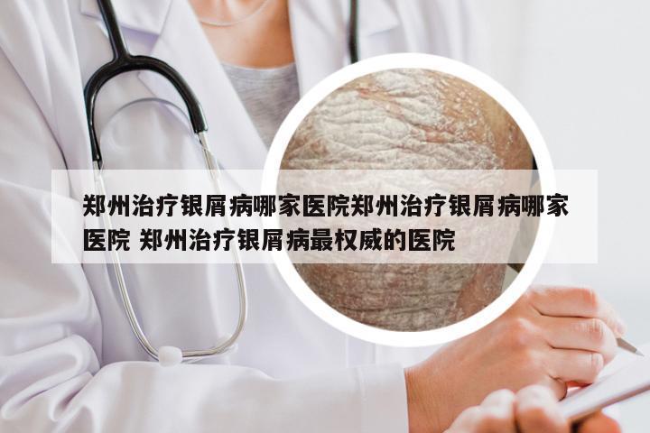 郑州治疗银屑病哪家医院郑州治疗银屑病哪家医院 郑州治疗银屑病最权威的医院