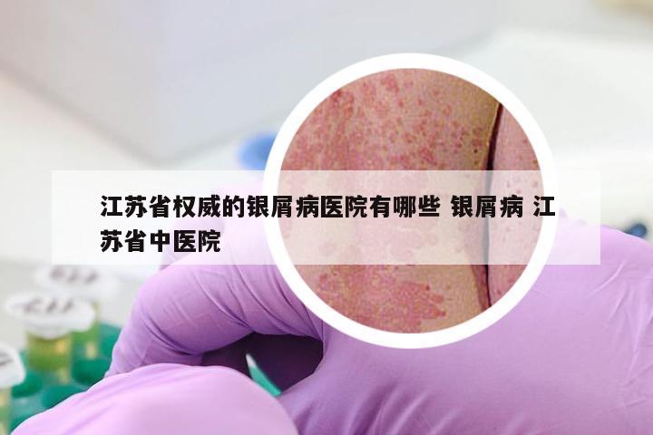 江苏省权威的银屑病医院有哪些 银屑病 江苏省中医院