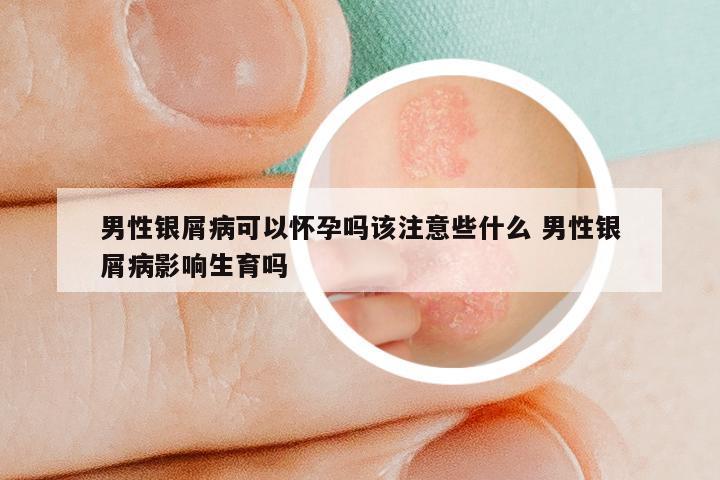 男性银屑病可以怀孕吗该注意些什么 男性银屑病影响生育吗