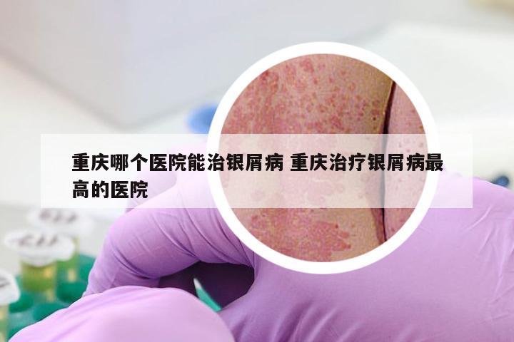 重庆哪个医院能治银屑病 重庆治疗银屑病最高的医院